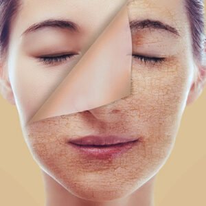 Acne Disease and His Homeopathy Medicines